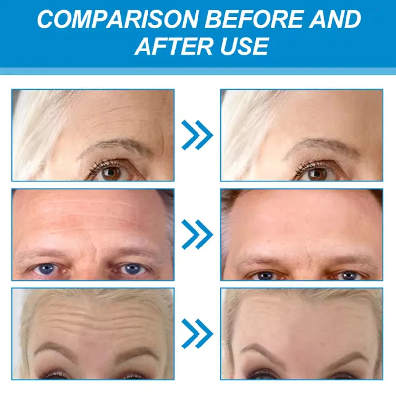 5 pièces/ensemble patchs Hydrogel Film Anti rides supprimer les cernes nourrir masque hydratant ascenseur raffermissant peau yeux front soin